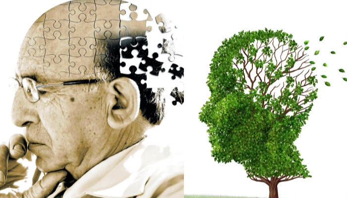 Alzheimer là gì?